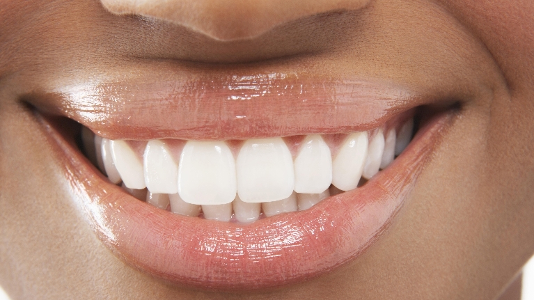 black woman smiles dental Lumineers