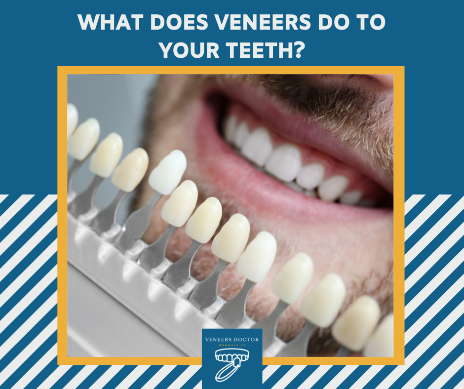 What Veneers Do to Your Teeth?
